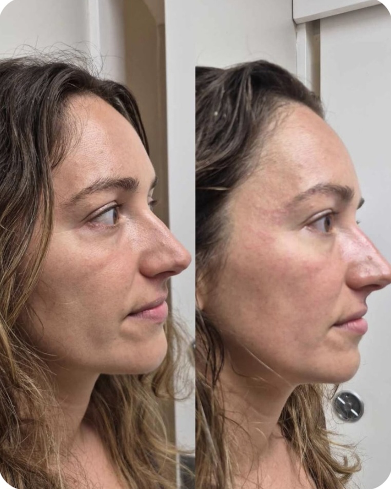 Before and after side profile showing a lifted cheek and more defined jawline after NeoLifting treatment