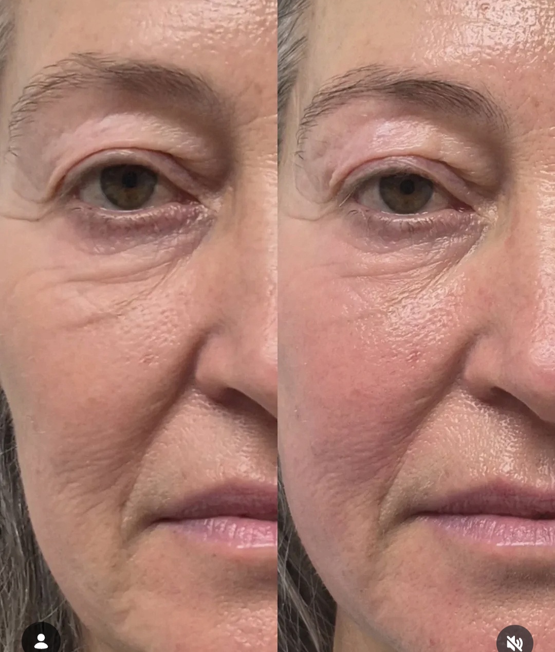 Before and after close-up showing smoother under-eye area and lifted upper eye contour after treatment