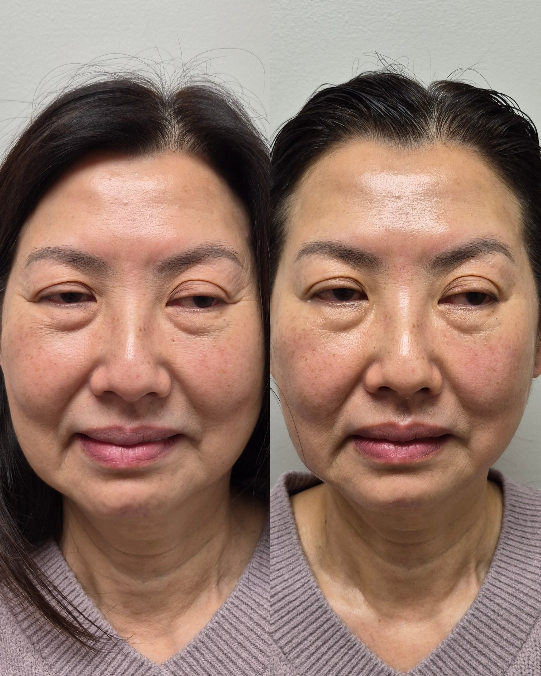 Before and after front portrait of a mature client showing lifted eyelids and smoother lower face after NeoLifting treatment