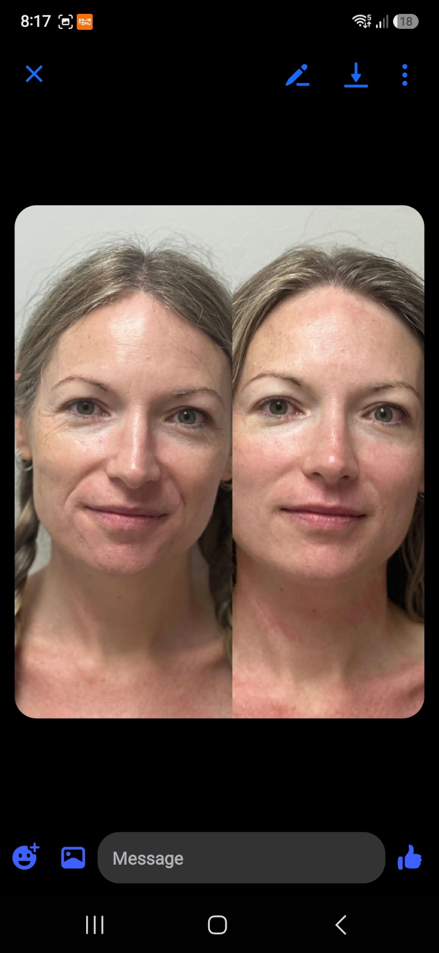 Before and after front portrait showing smoother, more lifted facial appearance after treatment