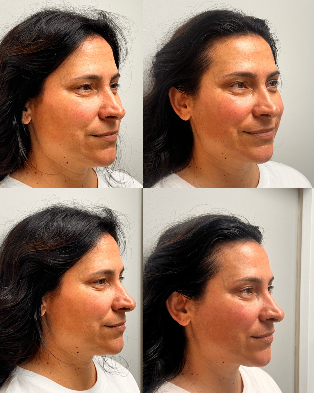 Before and after collage of side profiles showing lifted contour and released tension after NeoLifting treatment