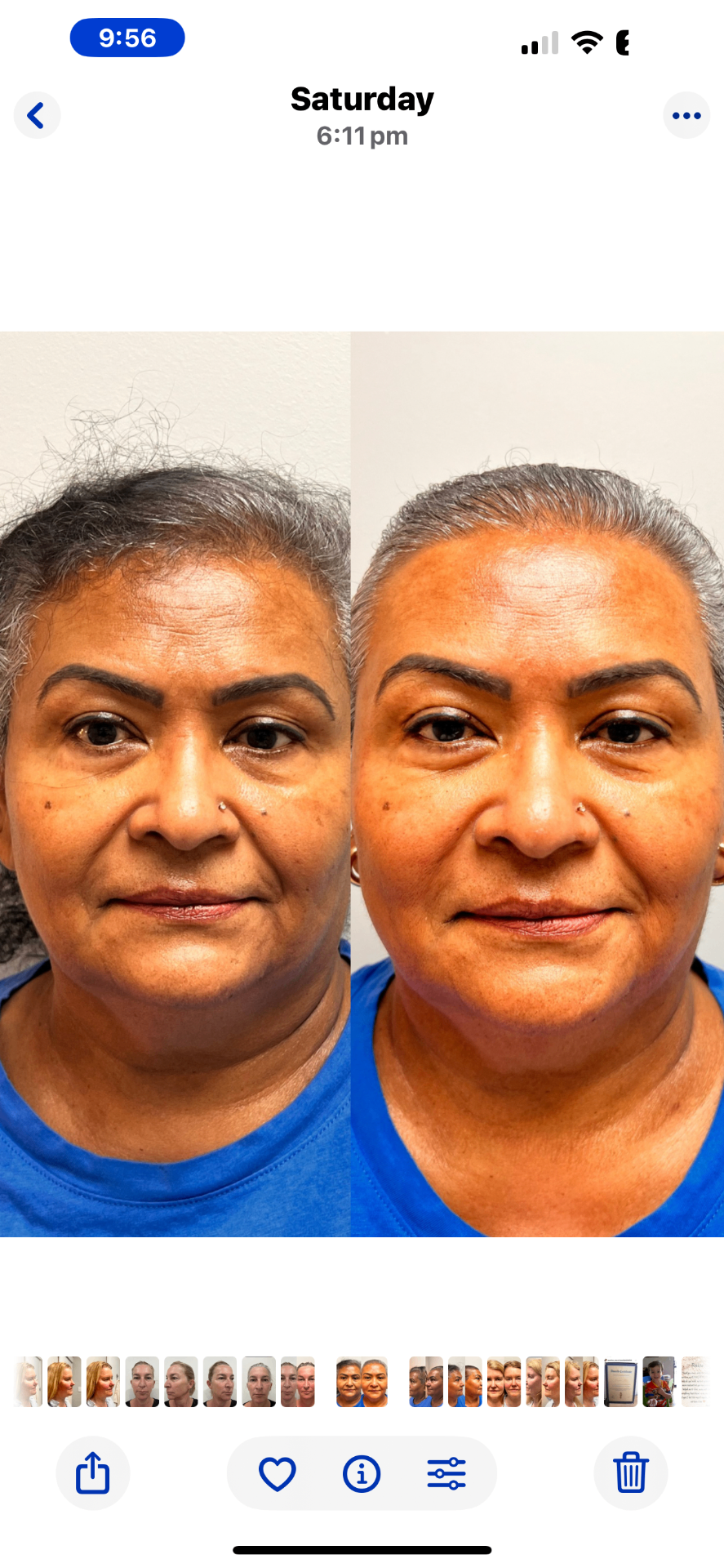Before and after front portrait showing a more sculpted jawline and lifted mid-face after NeoLifting treatment
