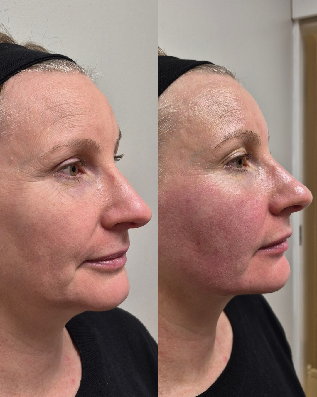 Before and after side profile of a mature client showing a lifted jawline and smoother neck after NeoLifting treatment