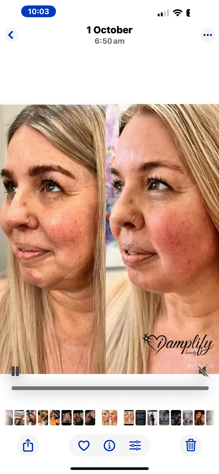 Before and after side profile showing lifted cheek, smoother skin and a glowing complexion after treatment