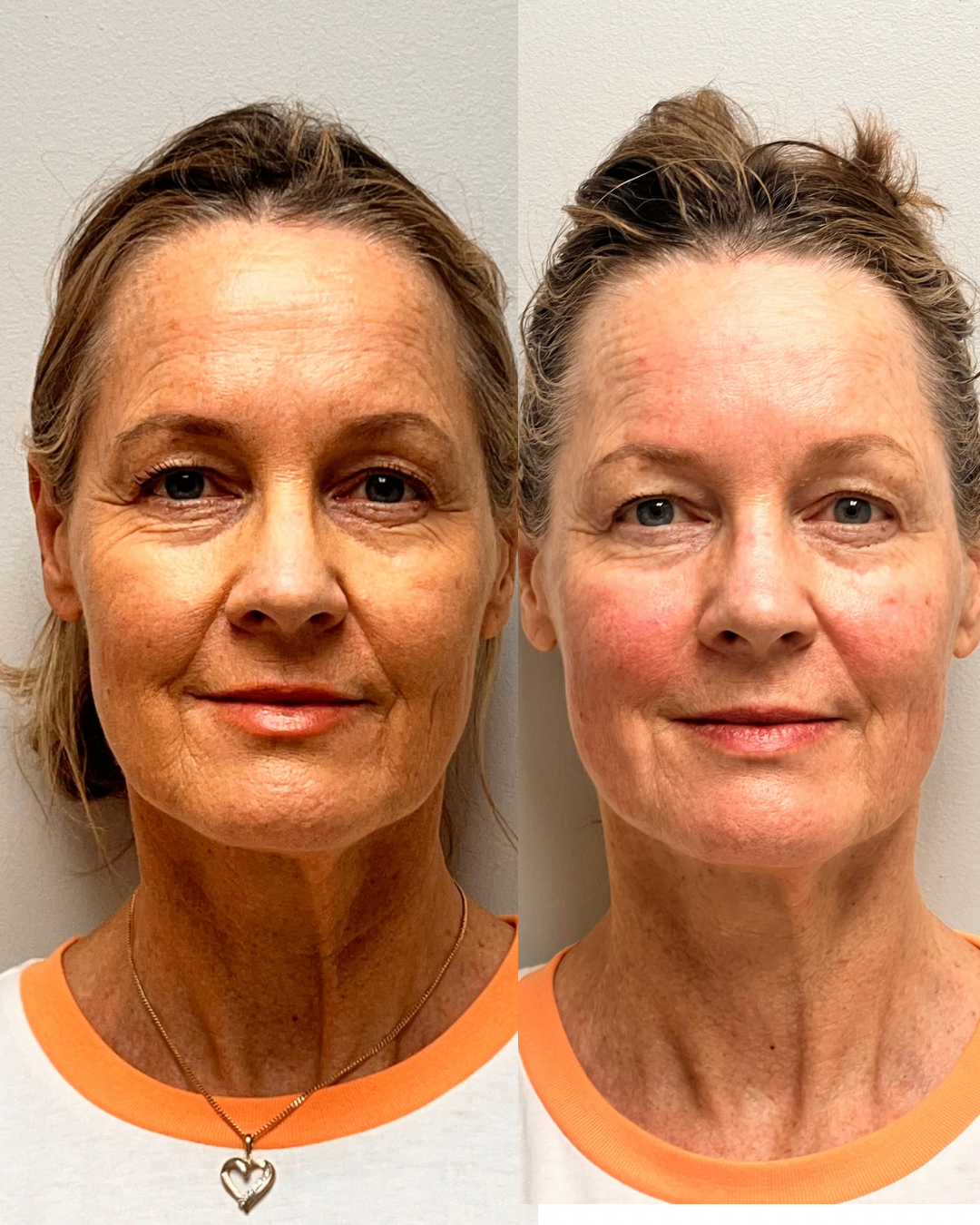 Before and after front portrait showing smoother skin texture and lifted facial contours after treatment