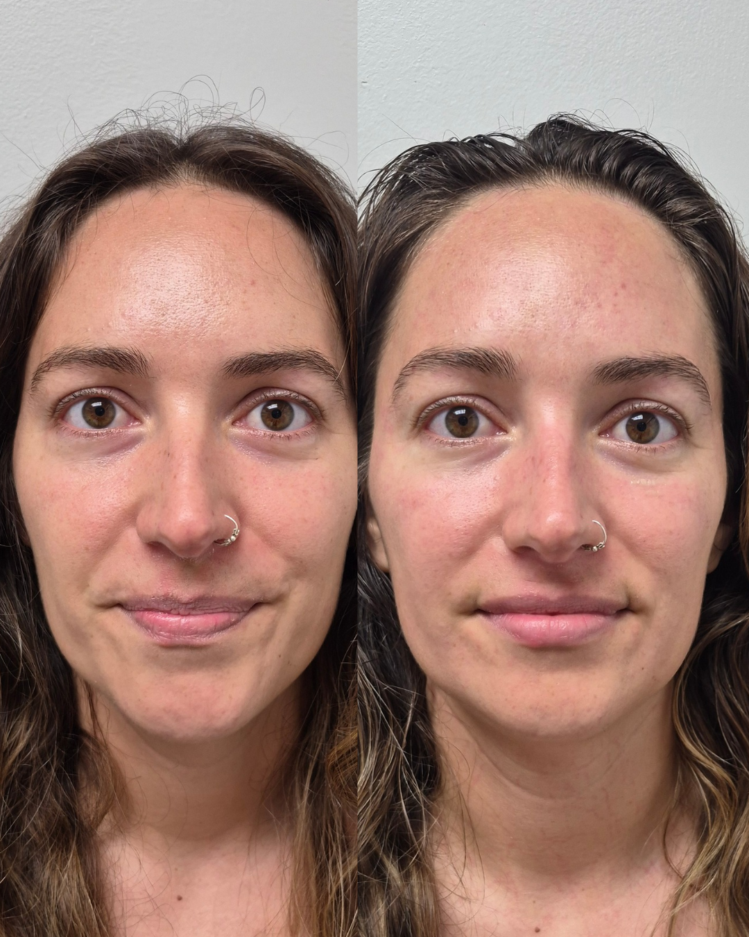 Before and after front portrait showing brighter skin and lifted mid-face after NeoLifting treatment