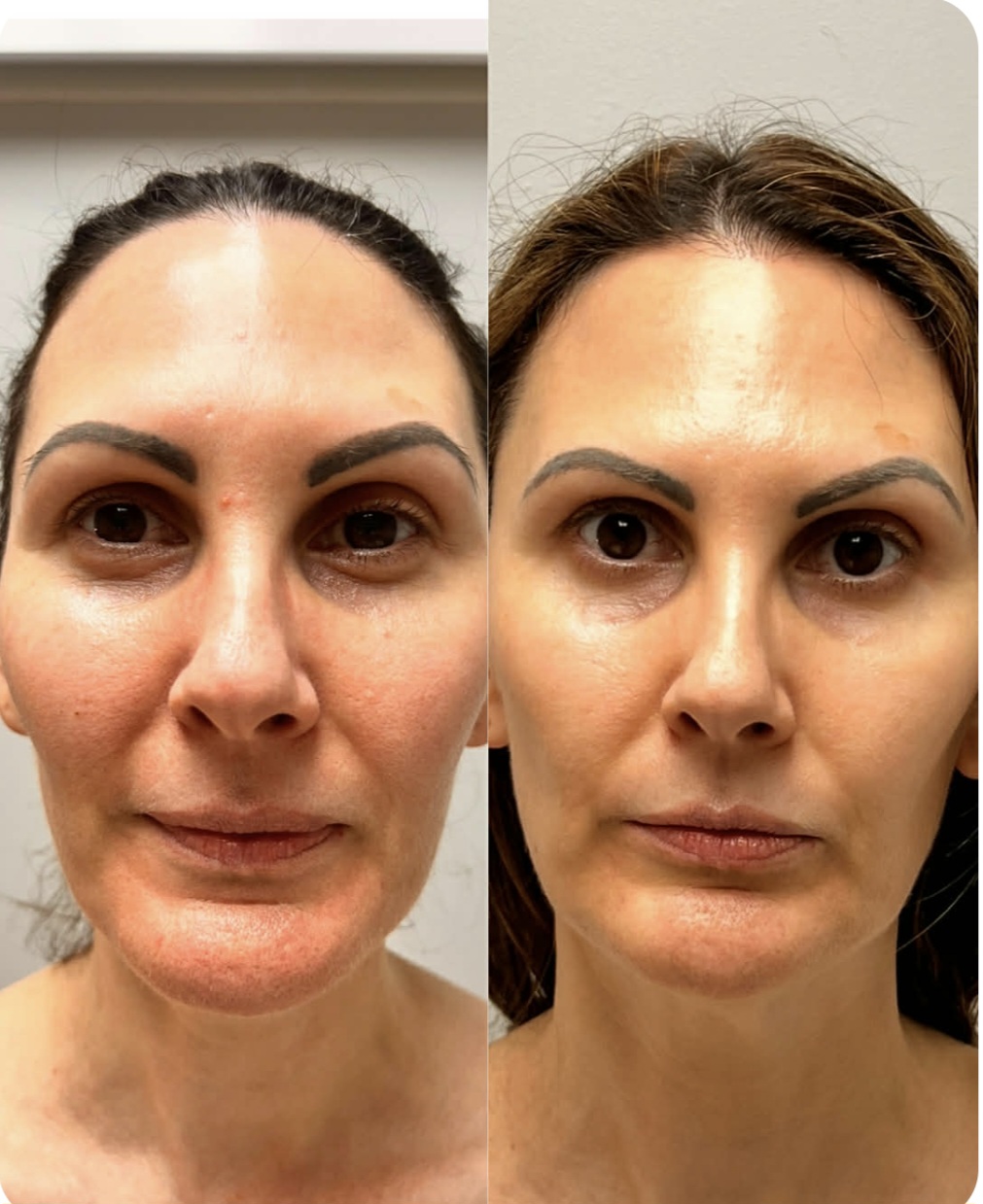 Before and after front portrait showing brighter, more lifted facial contours and clearer skin after NeoLifting treatment