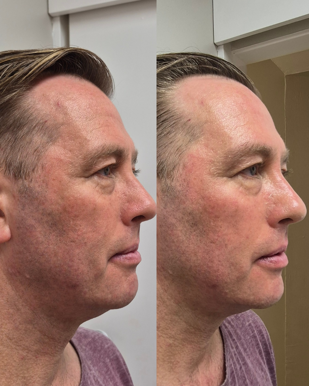 Before and after side profile showing lifted cheek contour and softer jawline tension after treatment