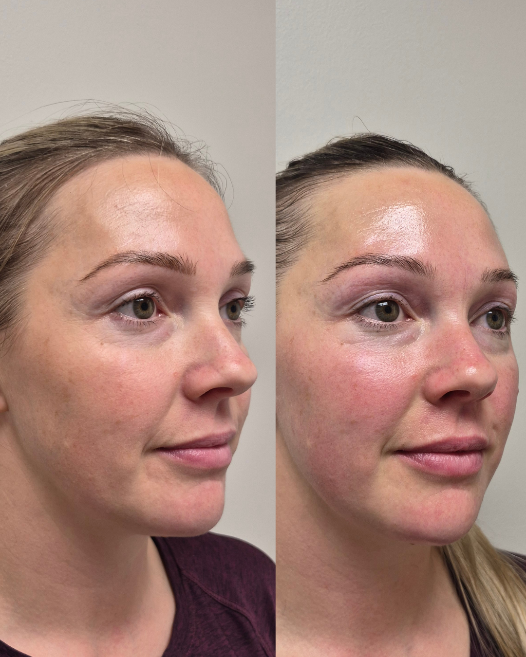 Before and after three-quarter portrait showing reduced puffiness and a firmer jawline after NeoLifting treatment