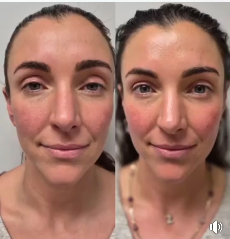 Before and after front portrait showing smoother nasolabial lines and a lifted, more even complexion after NeoLifting treatment