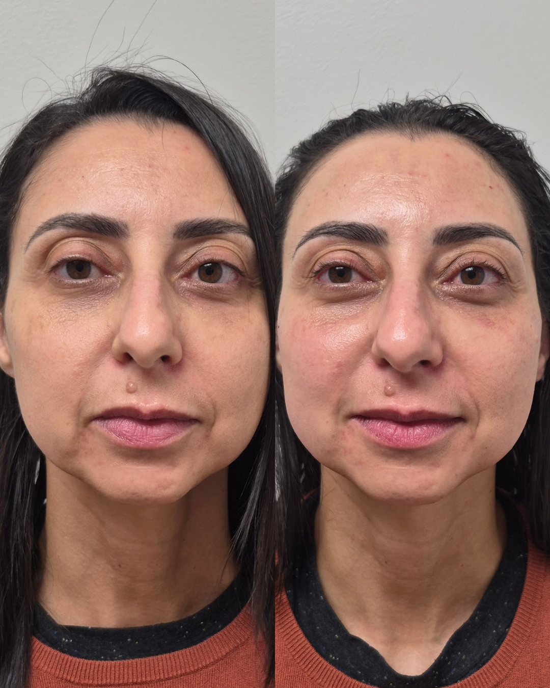 Before and after front portrait showing improved facial contour and softer tension across the mid-face