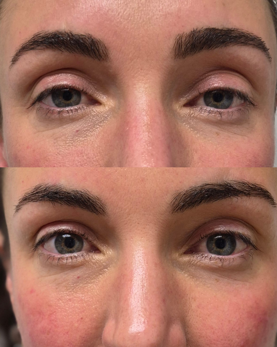 Before and after close-up of the eyes showing smoother under-eye texture and more open eyelids after NeoLifting treatment