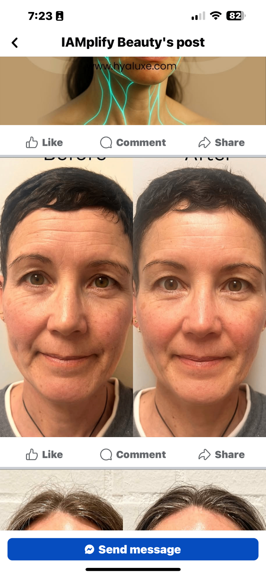 Before and after front portrait showing smoother, more lifted facial contours and released neck tension after NeoLifting treatment