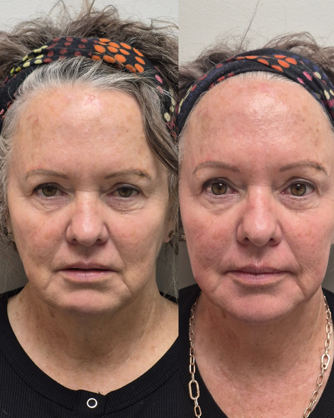 Before and after front portrait showing a brighter, more rested appearance after treatment