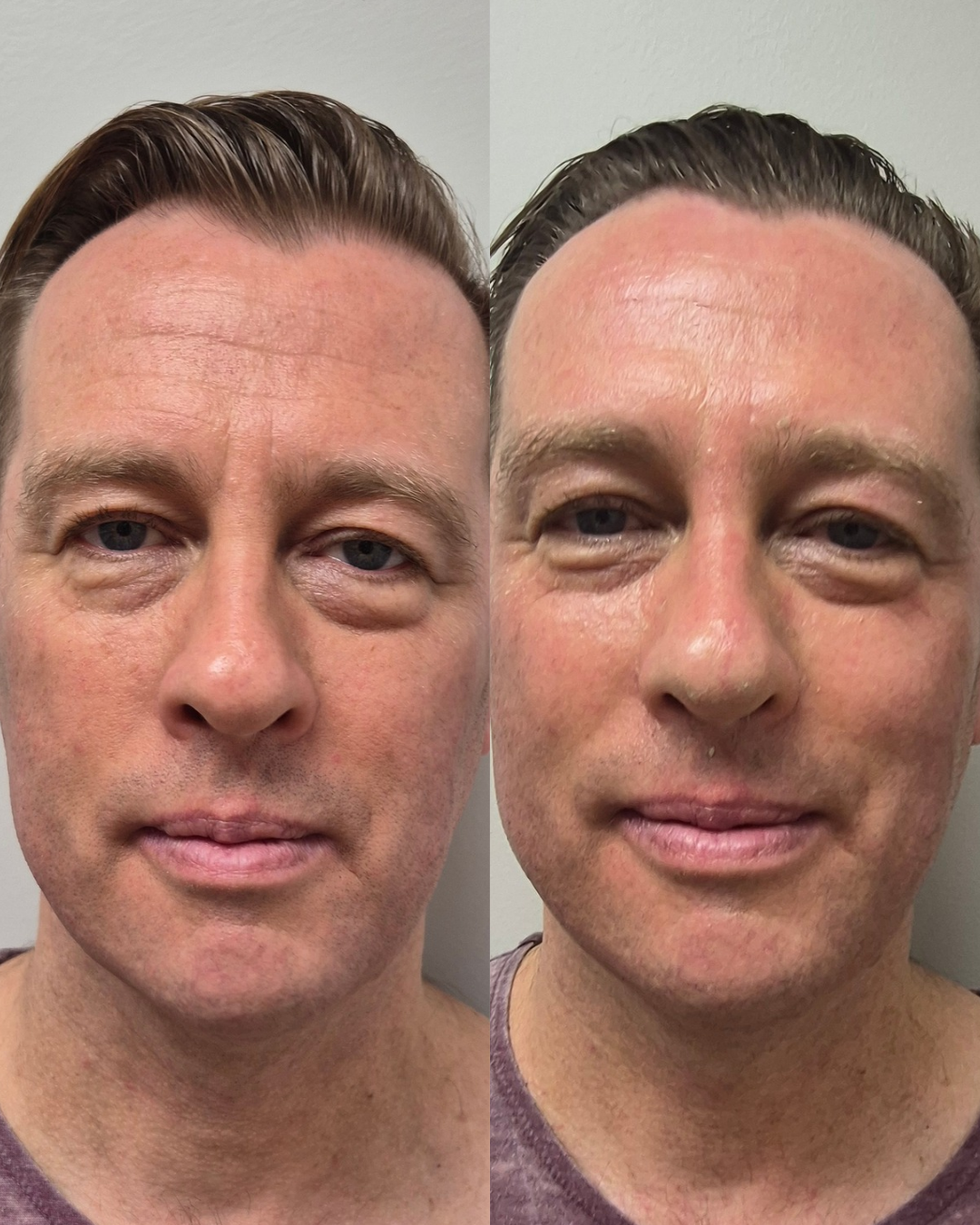 Before and after front portrait showing brighter expression and more lifted facial symmetry after treatment