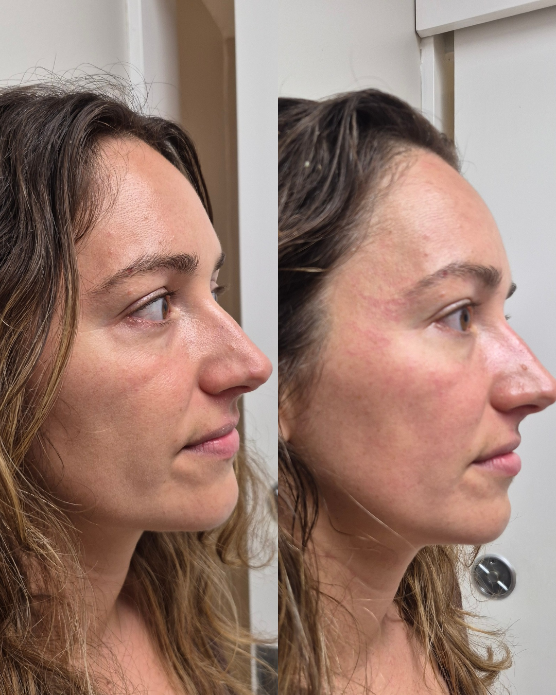 Before and after side profile showing released tension and a more sculpted cheek after NeoLifting treatment