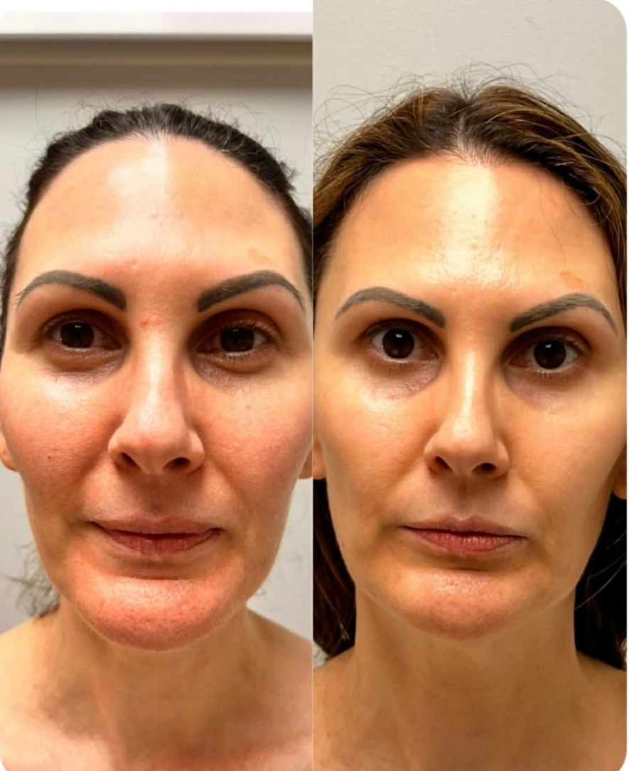 Before and after front portrait showing reduced puffiness, brighter under eyes and a more defined jawline after NeoLifting treatment