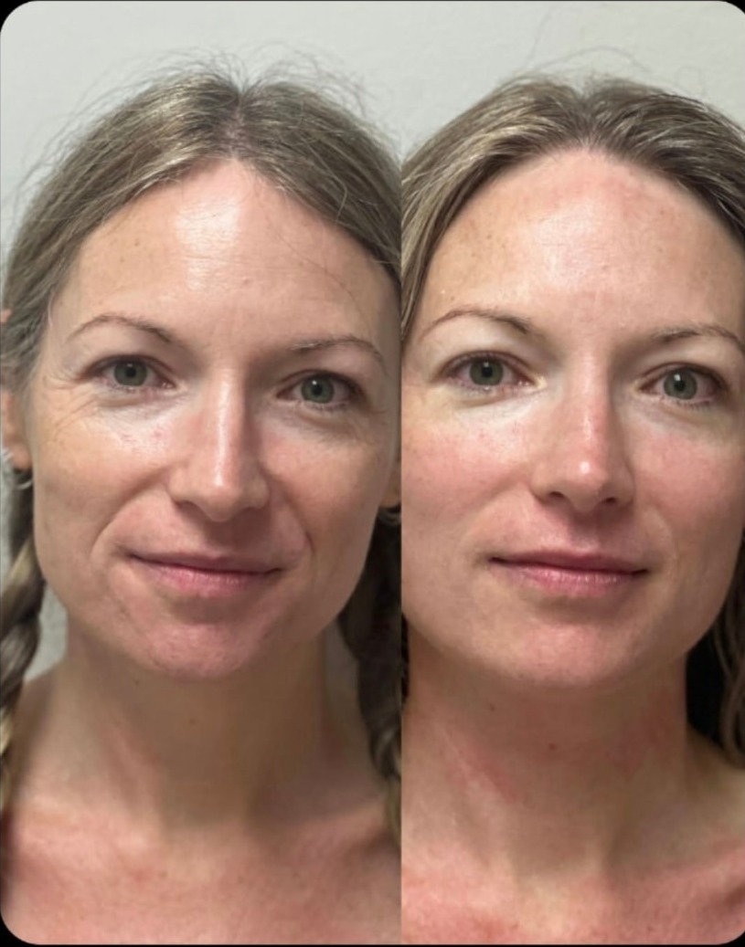 Before and after front portrait showing smoother nasolabial lines and a lifted, more even mid-face after NeoLifting treatment