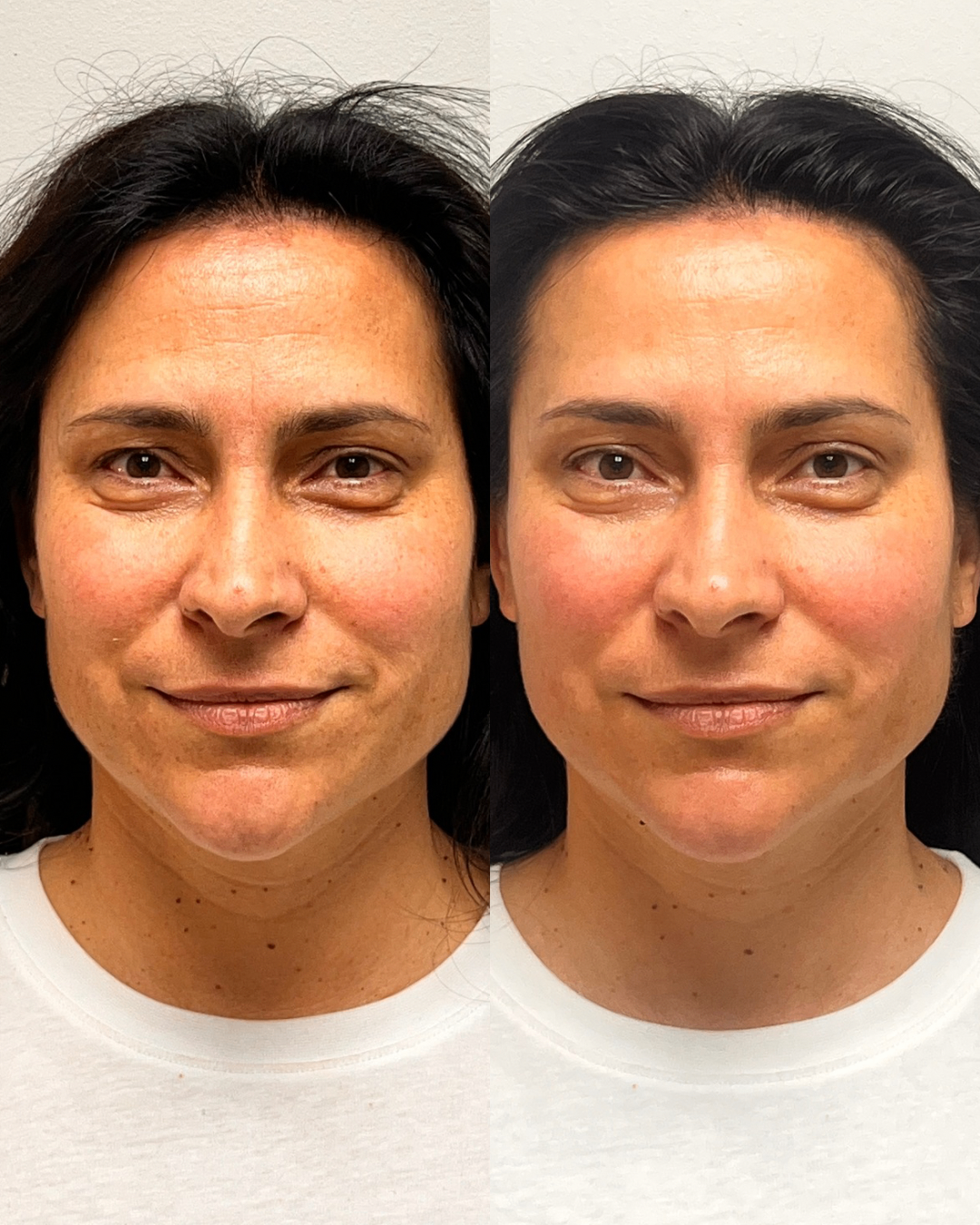Before and after front portrait showing clearer, brighter skin and lifted facial symmetry after treatment