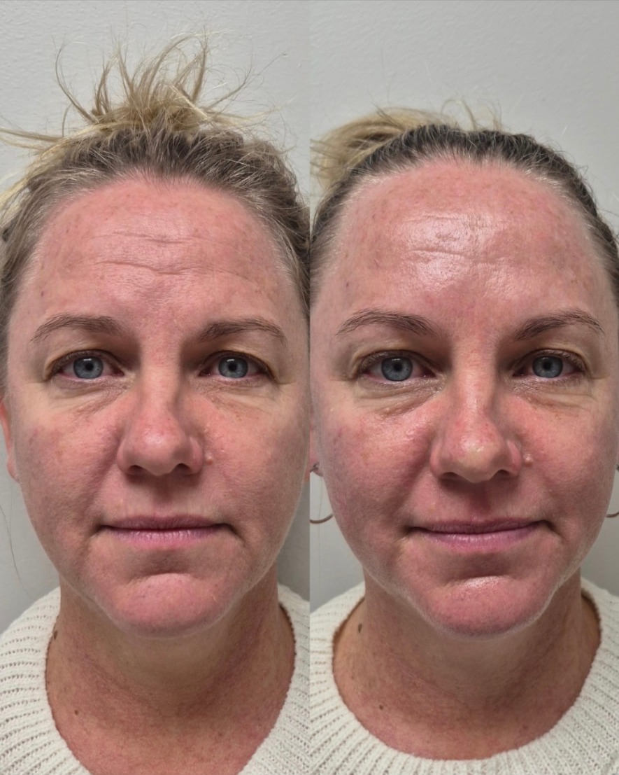 Before and after front portrait showing a smoother forehead, lifted brows and firmer jawline after NeoLifting treatment