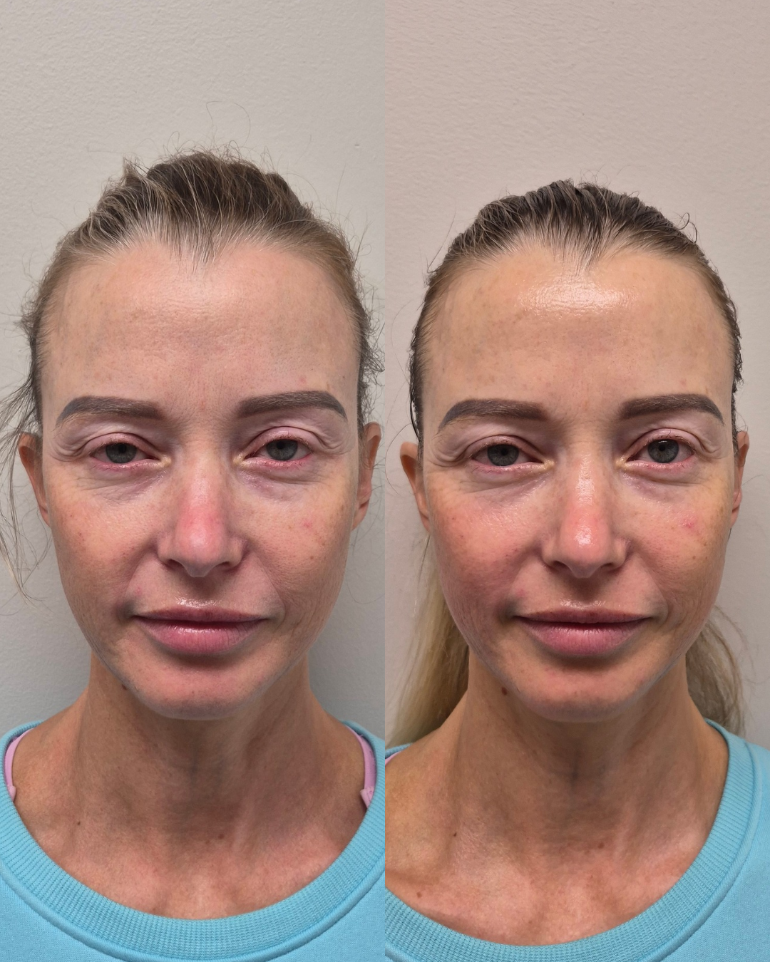 Before and after front portrait showing lifted, fresher facial contours after treatment