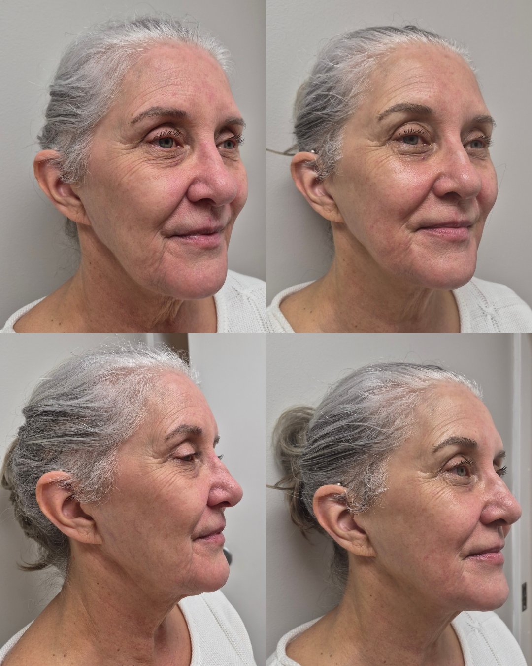 Before and after collage showing multiple angles of facial contour improvement after treatment