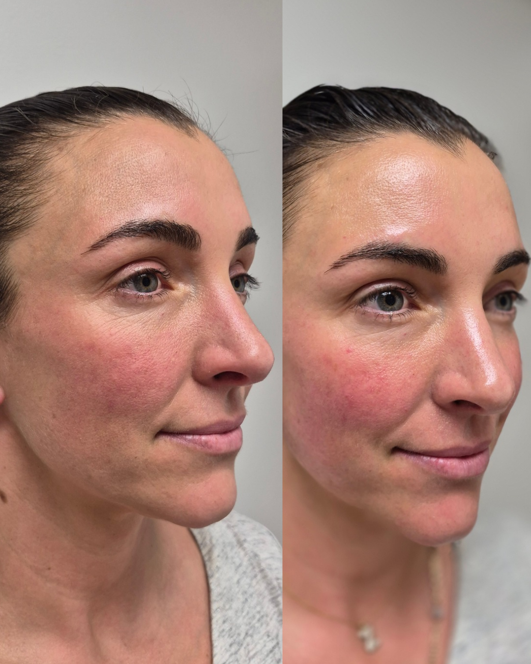 Before and after three-quarter portrait showing lifted cheekbones and glowing skin after NeoLifting treatment